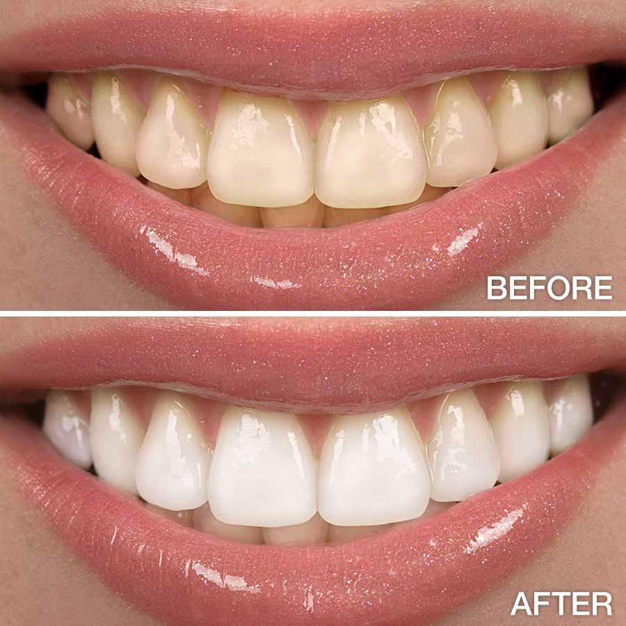 BrightSwipe™ Dual-Peroxide Formula & Xylitol